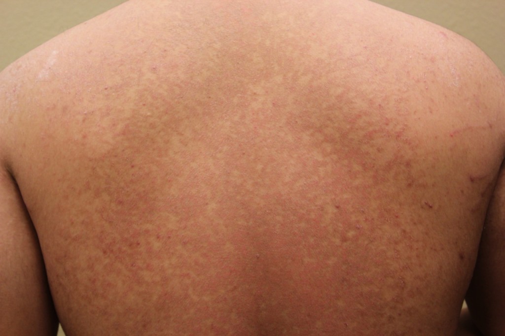 Tinea Versicolor: Cause, Symptoms, and Treatments