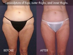 liposuction-procedure-photo1