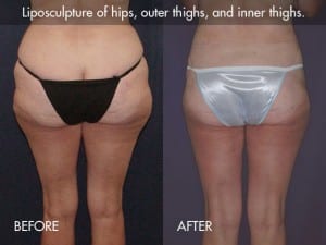 liposuction-procedure-photo2