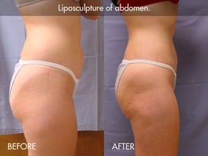 liposuction-procedure-photo3
