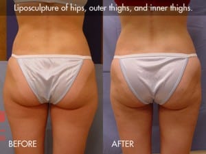 liposuction-procedure-photo4