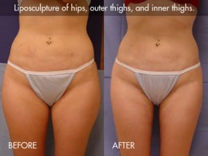 liposuction-procedure-photo5